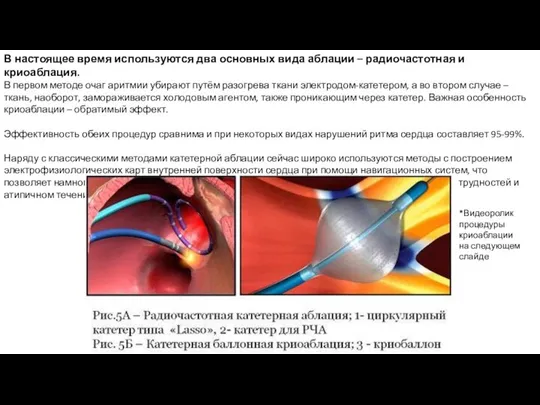 В настоящее время используются два основных вида аблации – радиочастотная и криоаблация.