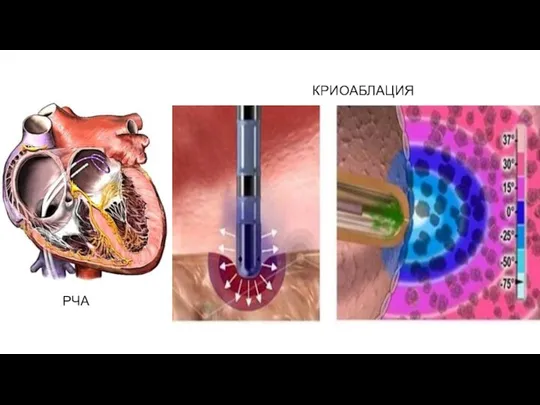 РЧА КРИОАБЛАЦИЯ