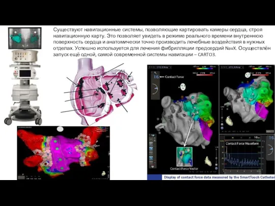 Существуют навигационные системы, позволяющие картировать камеры сердца, строя навигационную карту. Это позволяет