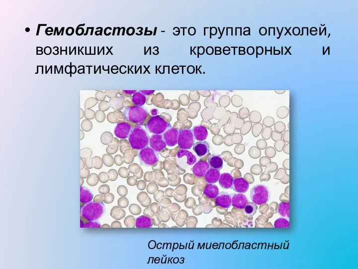 Гемобластозы - это группа опухолей, возникших из кроветворных и лимфатических клеток. Острый миелобластный лейкоз