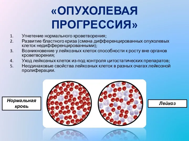 «ОПУХОЛЕВАЯ ПРОГРЕССИЯ» Угнетение нормального кроветворения; Развитие бластного криза (смена дифференцированных опухолевых клеток