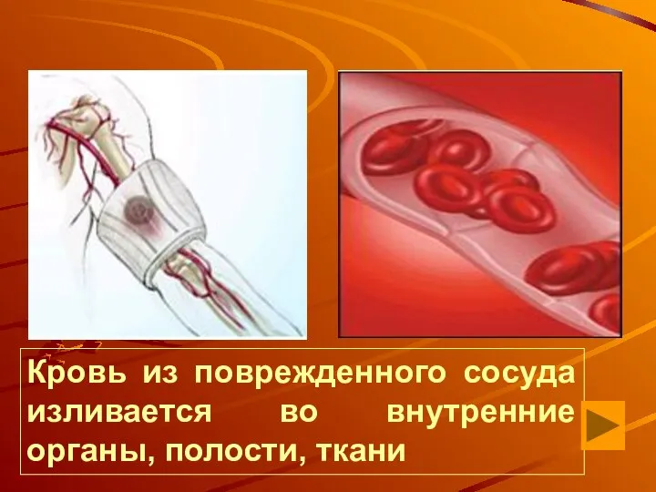 Кровь из поврежденного сосуда изливается во внутренние органы, полости, ткани