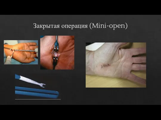 Закрытая операция (Mini-open)