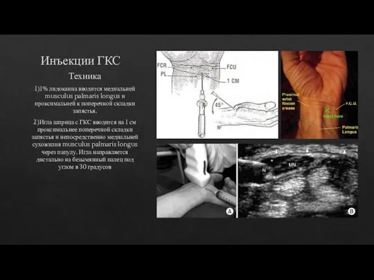 Инъекции ГКС Техника 1)1% лидокаина вводится медиальней musculus palmaris longus и проксимальней