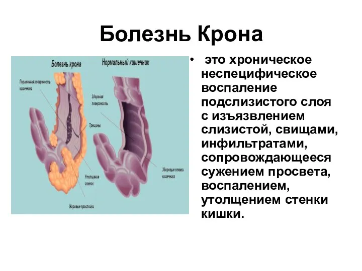 Болезнь Крона это хроническое неспецифическое воспаление подслизистого слоя с изъязвлением слизистой, свищами,