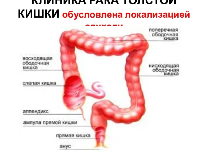 КЛИНИКА РАКА ТОЛСТОЙ КИШКИ обусловлена локализацией опухоли