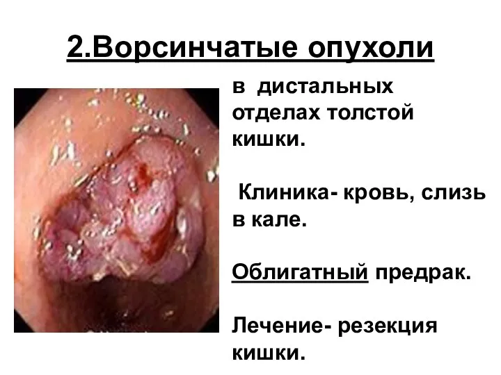 2.Ворсинчатые опухоли в дистальных отделах толстой кишки. Клиника- кровь, слизь в кале.