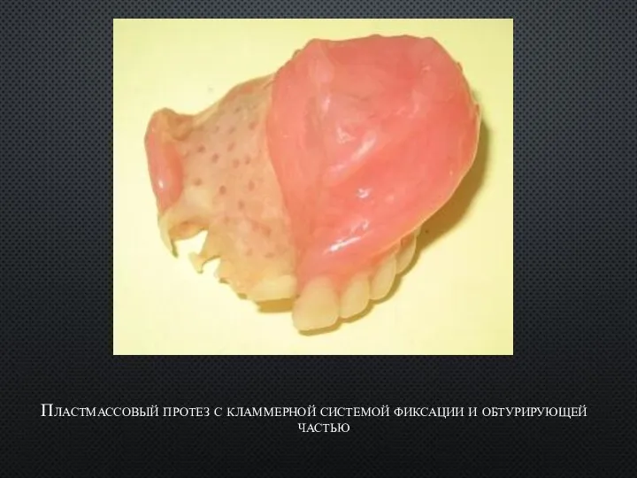 Пластмассовый протез с кламмерной системой фиксации и обтурирующей частью