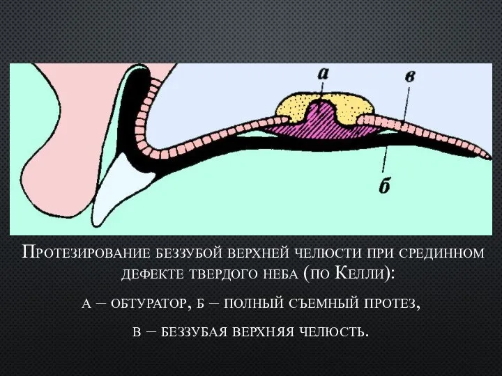 Протезирование беззубой верхней челюсти при срединном дефекте твердого неба (по Келли): а