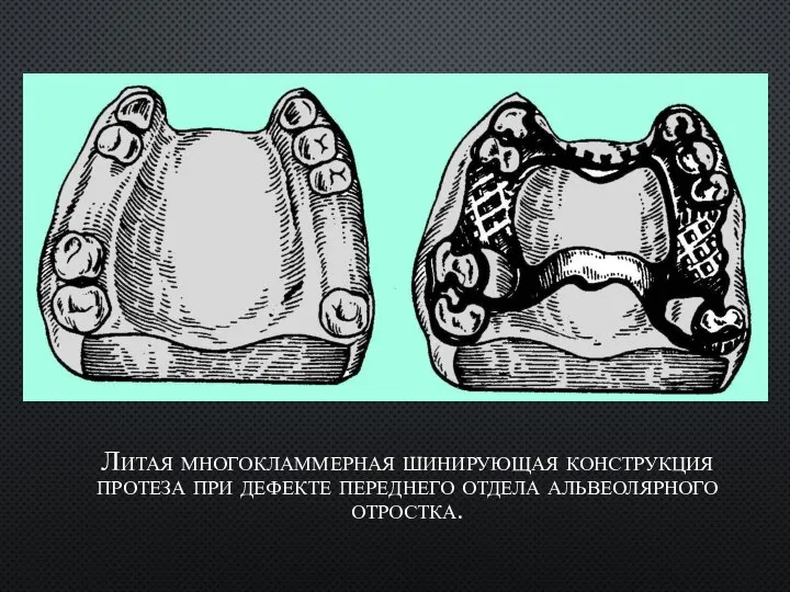 Литая многокламмерная шинирующая конструкция протеза при дефекте переднего отдела альвеолярного отростка.