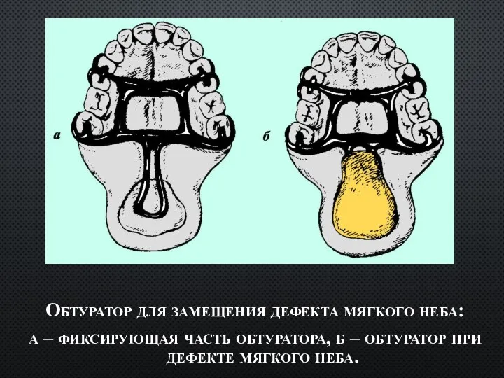 Обтуратор для замещения дефекта мягкого неба: а – фиксирующая часть обтуратора, б