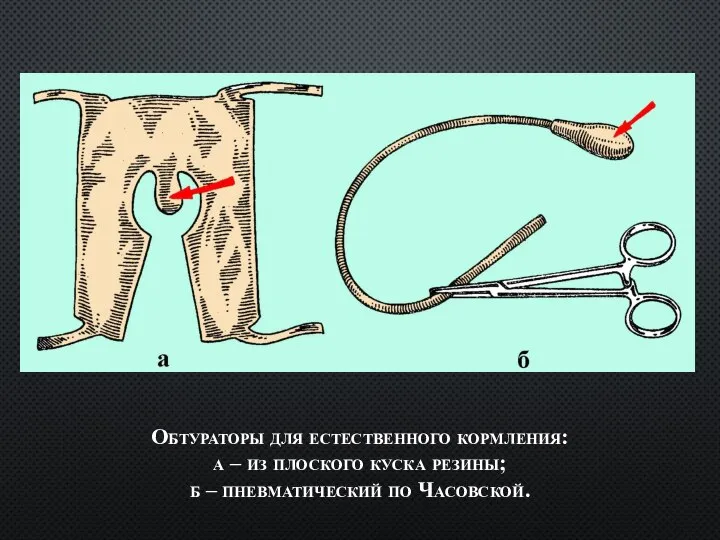Обтураторы для естественного кормления: а – из плоского куска резины; б – пневматический по Часовской.