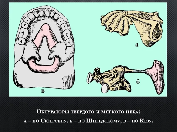 Обтураторы твердого и мягкого неба: а – по Сюерсену, б – по