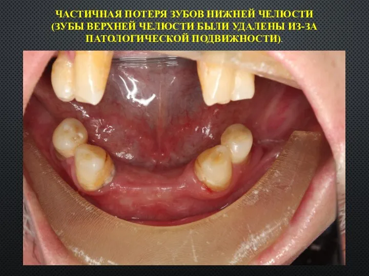 ЧАСТИЧНАЯ ПОТЕРЯ ЗУБОВ НИЖНЕЙ ЧЕЛЮСТИ (ЗУБЫ ВЕРХНЕЙ ЧЕЛЮСТИ БЫЛИ УДАЛЕНЫ ИЗ-ЗА ПАТОЛОГИЧЕСКОЙ ПОДВИЖНОСТИ).