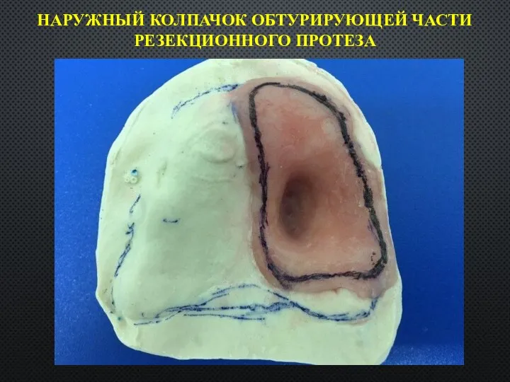 НАРУЖНЫЙ КОЛПАЧОК ОБТУРИРУЮЩЕЙ ЧАСТИ РЕЗЕКЦИОННОГО ПРОТЕЗА