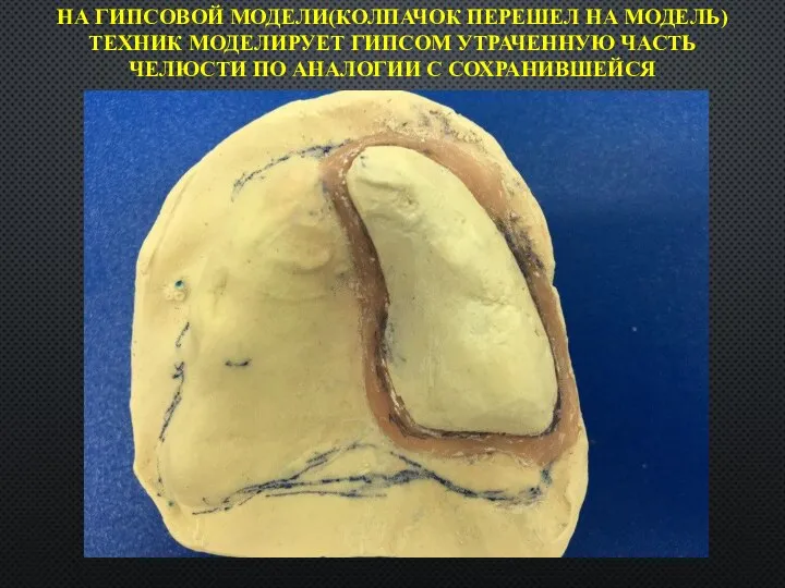 НА ГИПСОВОЙ МОДЕЛИ(КОЛПАЧОК ПЕРЕШЕЛ НА МОДЕЛЬ) ТЕХНИК МОДЕЛИРУЕТ ГИПСОМ УТРАЧЕННУЮ ЧАСТЬ ЧЕЛЮСТИ ПО АНАЛОГИИ С СОХРАНИВШЕЙСЯ