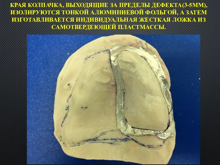 КРАЯ КОЛПАЧКА, ВЫХОДЯЩИЕ ЗА ПРЕДЕЛЫ ДЕФЕКТА(3-5ММ), ИЗОЛИРУЮТСЯ ТОНКОЙ АЛЮМИНИЕВОЙ ФОЛЬГОЙ, А ЗАТЕМ