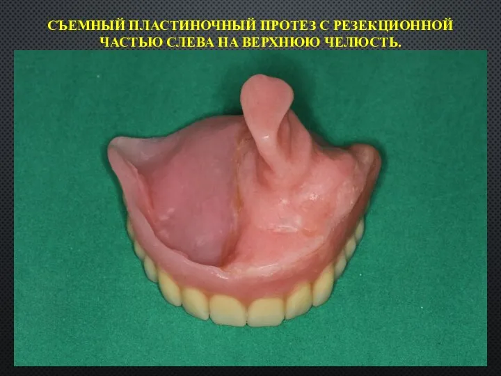 СЪЕМНЫЙ ПЛАСТИНОЧНЫЙ ПРОТЕЗ С РЕЗЕКЦИОННОЙ ЧАСТЬЮ СЛЕВА НА ВЕРХНЮЮ ЧЕЛЮСТЬ.