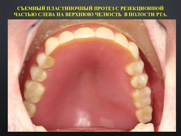 СЪЕМНЫЙ ПЛАСТИНОЧНЫЙ ПРОТЕЗ С РЕЗЕКЦИОННОЙ ЧАСТЬЮ СЛЕВА НА ВЕРХНЮЮ ЧЕЛЮСТЬ В ПОЛОСТИ РТА.