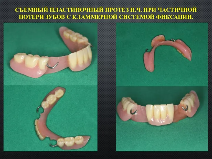 СЪЕМНЫЙ ПЛАСТИНОЧНЫЙ ПРОТЕЗ Н.Ч. ПРИ ЧАСТИЧНОЙ ПОТЕРИ ЗУБОВ С КЛАММЕРНОЙ СИСТЕМОЙ ФИКСАЦИИ.
