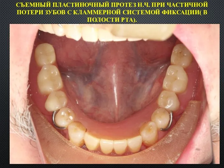 СЪЕМНЫЙ ПЛАСТИНОЧНЫЙ ПРОТЕЗ Н.Ч. ПРИ ЧАСТИЧНОЙ ПОТЕРИ ЗУБОВ С КЛАММЕРНОЙ СИСТЕМОЙ ФИКСАЦИИ( В ПОЛОСТИ РТА).