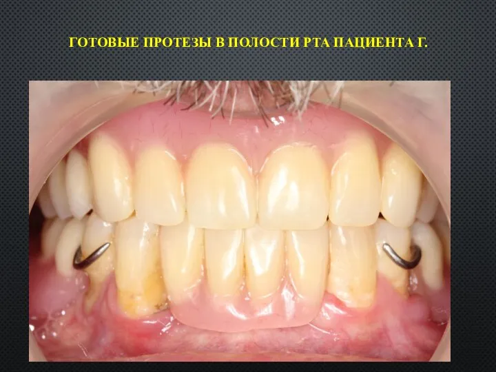 ГОТОВЫЕ ПРОТЕЗЫ В ПОЛОСТИ РТА ПАЦИЕНТА Г.