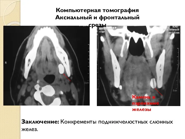 Заключение: Конкременты поднижчелюстных слюнных желез. Компьютерная томография Аксиальный и фронтальный срезы Камень в паренхиме железы