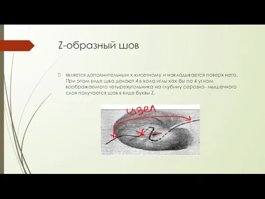 Z-образный шов является дополнительным к кисетному и накладывается поверх него. При этом