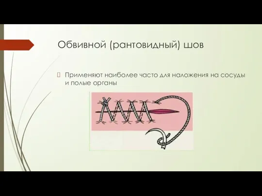 Обвивной (рантовидный) шов Применяют наиболее часто для наложения на сосуды и полые органы