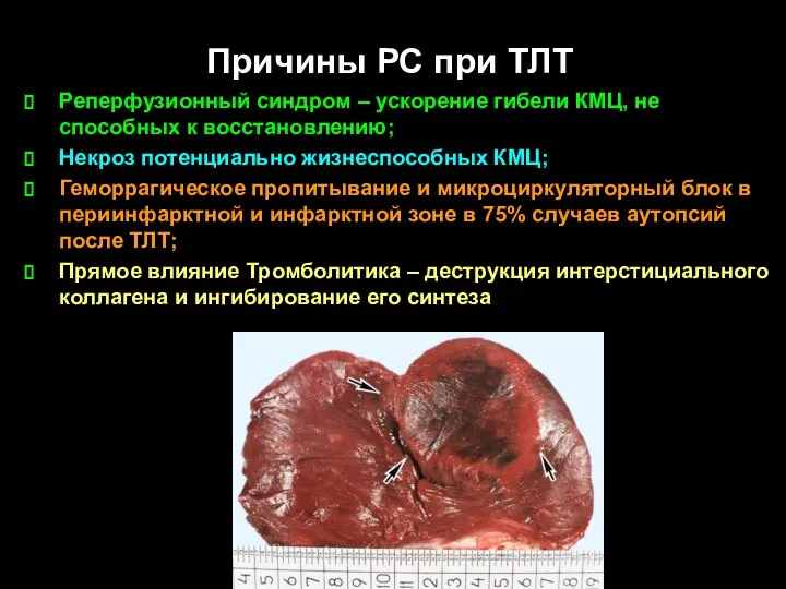 Причины РС при ТЛТ Реперфузионный синдром – ускорение гибели КМЦ, не способных