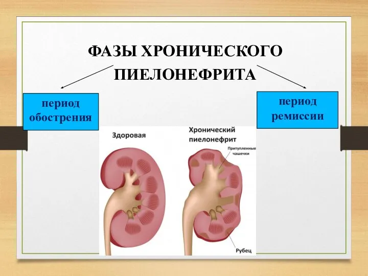 ФАЗЫ ХРОНИЧЕСКОГО ПИЕЛОНЕФРИТА период обострения период ремиссии