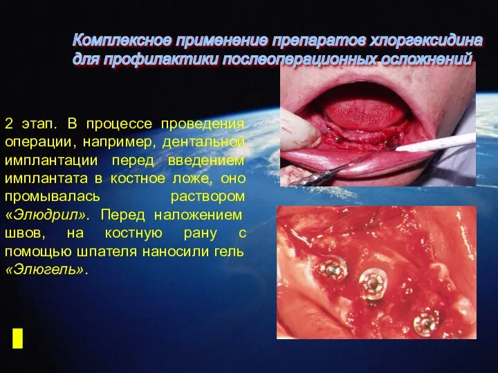 2 этап. В процессе проведения операции, например, дентальной имплантации перед введением имплантата