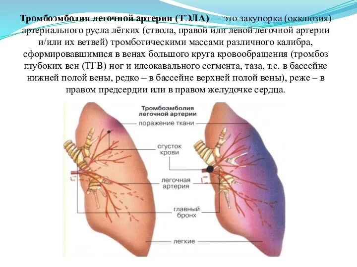 Тромбоэмболия легочной артерии (ТЭЛА) — это закупорка (окклюзия) артериального русла лёгких (ствола,