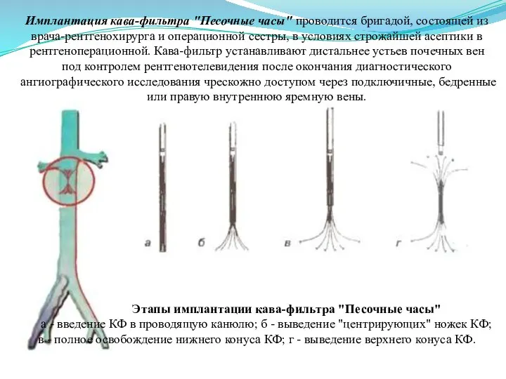 Имплантация кава-фильтра "Песочные часы" проводится бригадой, состоящей из врача-рентгенохирурга и операционной сестры,