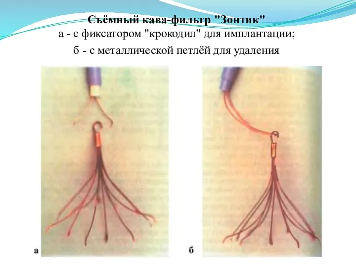 Съёмный кава-фильтр "Зонтик" а - с фиксатором "крокодил" для имплантации; б -