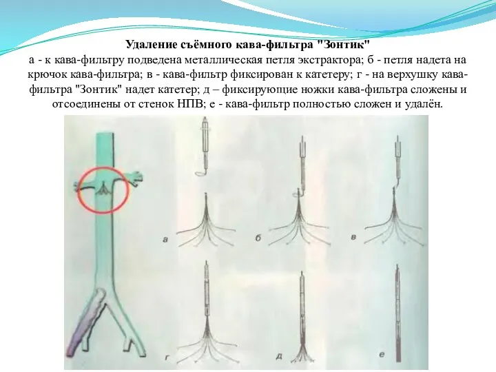 Удаление съёмного кава-фильтра "Зонтик" а - к кава-фильтру подведена металлическая петля экстрактора;