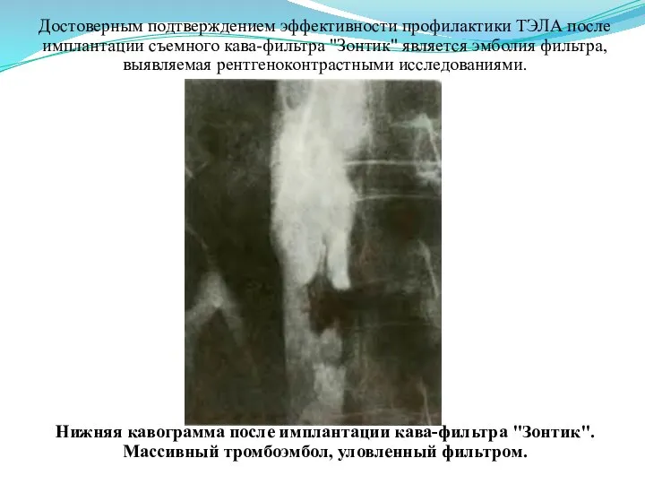 Достоверным подтверждением эффективности профилактики ТЭЛА после имплантации съемного кава-фильтра "Зонтик" является эмболия