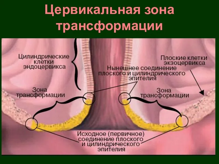 Цервикальная зона трансформации