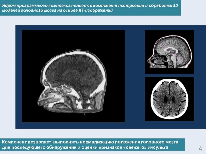 4 Компонент позволяет выполнять нормализацию положения головного мозга для последующего обнаружения и