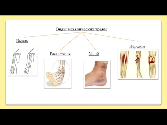 Виды механических травм Растяжение Вывих Ушиб Перелом