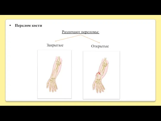 Перелом кости Открытые Различают переломы: Закрытые