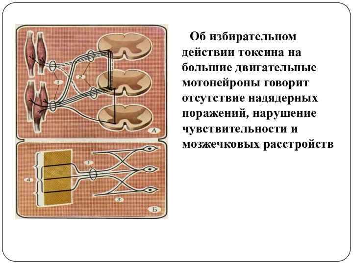 Об избирательном действии токсина на большие двигательные мотонейроны говорит отсутствие надядерных поражений,