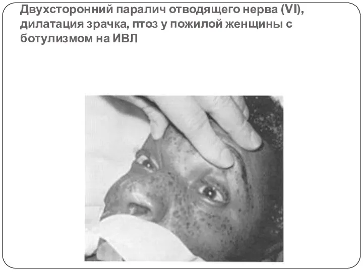 Двухсторонний паралич отводящего нерва (VI), дилатация зрачка, птоз у пожилой женщины с ботулизмом на ИВЛ