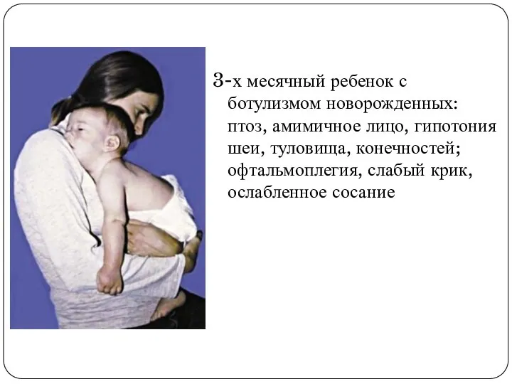 3-х месячный ребенок с ботулизмом новорожденных: птоз, амимичное лицо, гипотония шеи, туловища,