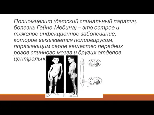 Полиомиелит (детский спинальный паралич, болезнь Гейне-Медина) – это острое и тяжелое инфекционное