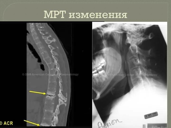 МРТ изменения