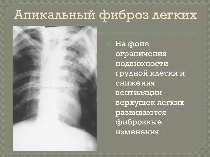 Апикальный фиброз легких На фоне ограничения подвижности грудной клетки и снижения вентиляции