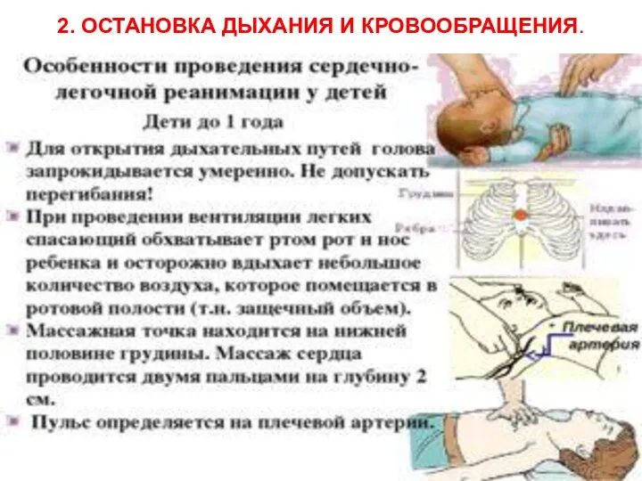 2. ОСТАНОВКА ДЫХАНИЯ И КРОВООБРАЩЕНИЯ.