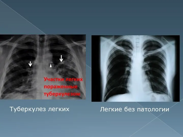 Легкие без патологии Туберкулез легких