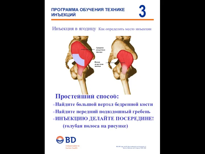 Инъекция в ягодицу Как определить место инъекции Простейший способ: Найдите большой вертел